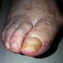 Фундизол отзывы при лечении грибка ногтей на ногах thumbnail